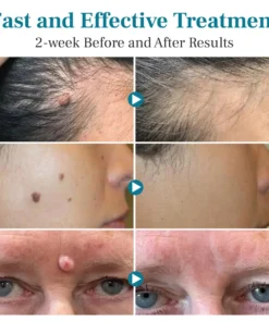 Alisanda™ LumeSkin Mole and Wart Removal Laser Pen