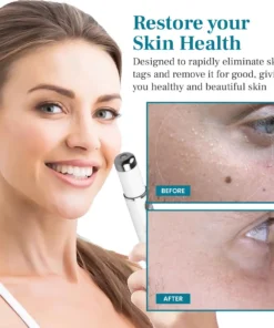 Alisanda™ LumeSkin Mole and Wart Removal Laser Pen