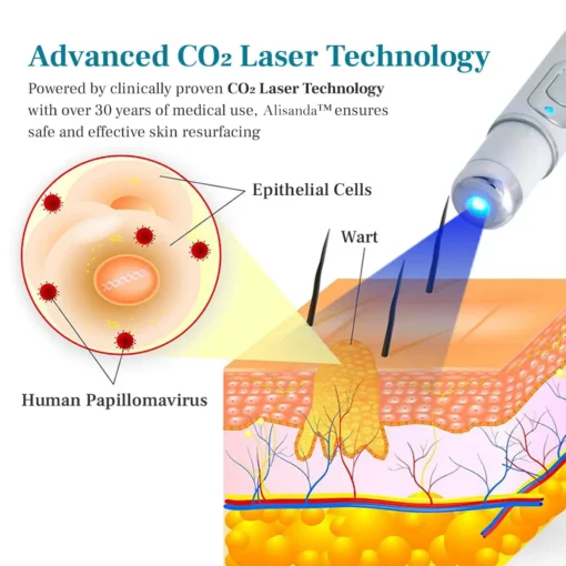 Alisanda™ LumeSkin Mole and Wart Removal Laser Pen