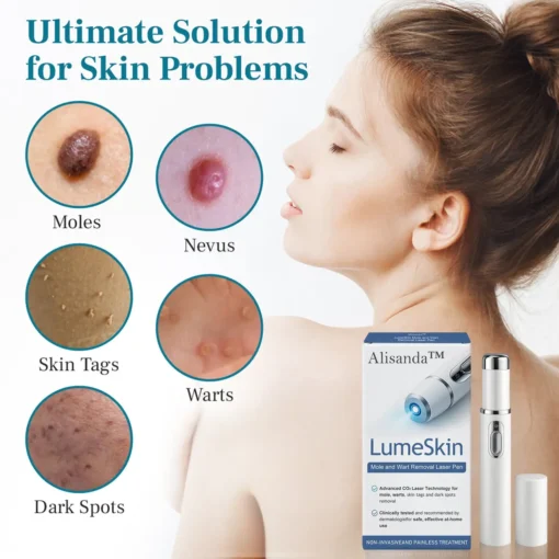 Alisanda™ LumeSkin Mole and Wart Removal Laser Pen