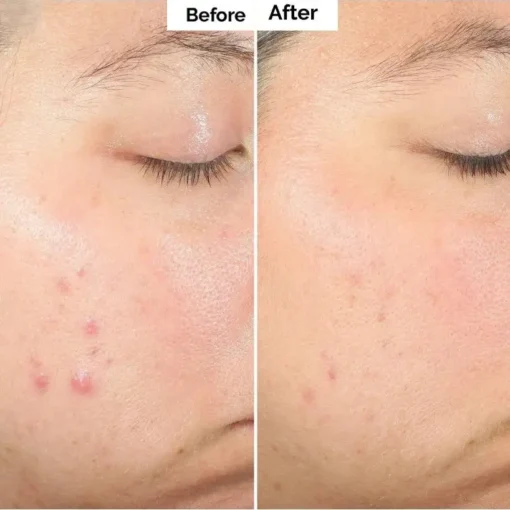 Alisanda™ Pore & Spot Care Duo| Shrinks Pores & Fades Blemish Marks