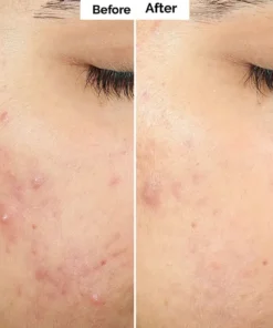 Alisanda™ Pore & Spot Care Duo| Shrinks Pores & Fades Blemish Marks