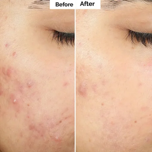 Alisanda™ Pore & Spot Care Duo| Shrinks Pores & Fades Blemish Marks