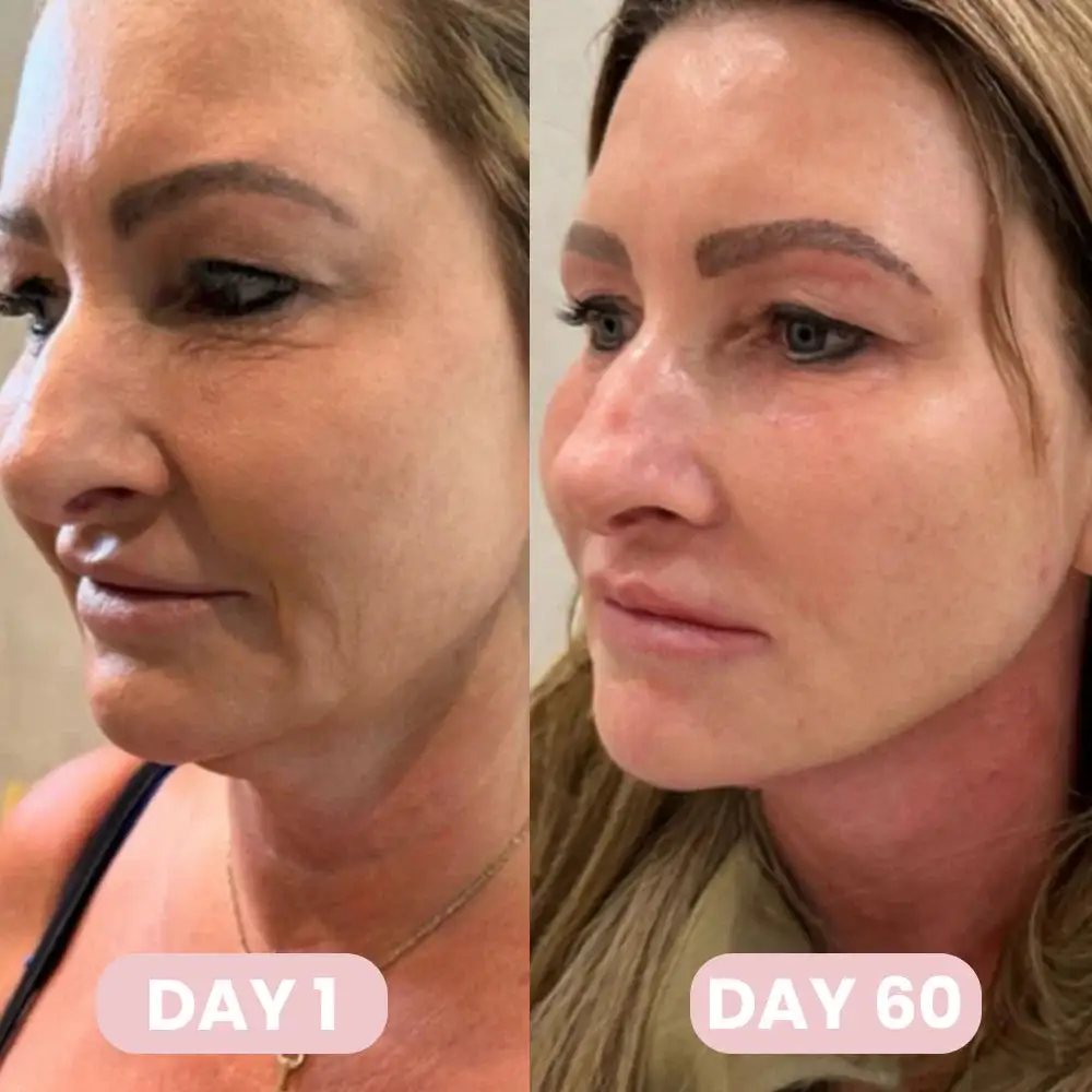 Alisanda™ GLP-1 Patches