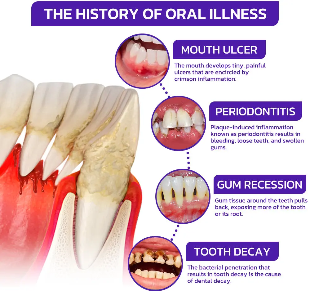 Alisanda® Bee Venom Dental Treatment Toothpaste