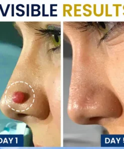 ALISANDA® Skin Tag Cryo Treatment Spray Precision Cryo-Tech Freezes Away Skin Tags Warts in Seconds No Blades, No Pain.