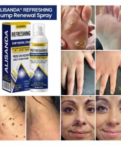 ALISANDA® Skin Tag Cryo Treatment Spray Precision Cryo-Tech Freezes Away Skin Tags Warts in Seconds No Blades, No Pain.
