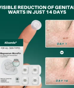 Alisanda® Magnesium MicroPin HPV Genital Wart Removal Patch