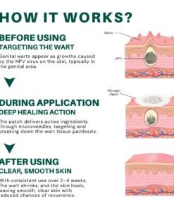 Alisanda® Magnesium MicroPin HPV Genital Wart Removal Patch