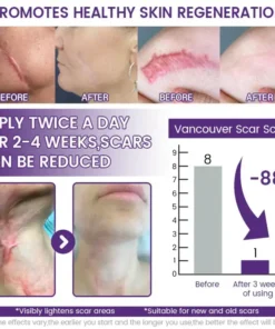 Alisanda® ReGenScar Rapid Recovery Scar Gel