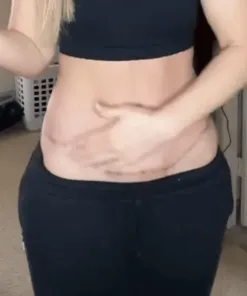 Alisanda® ReGenScar Rapid Recovery Scar Gel