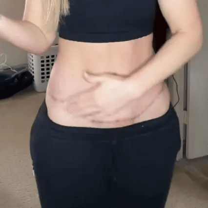 Alisanda® ReGenScar Rapid Recovery Scar Gel