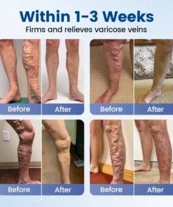 Alisanda® Vein Ease Microneedle Therapy Patch