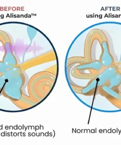 Alisanda® Tinnitus Relieving Device
