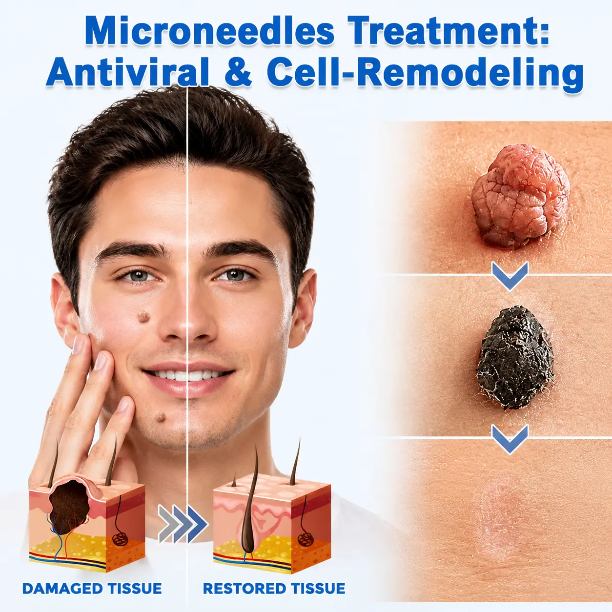 Alisanda®2-in-1 Microneedle & Hydrocolloid Patch