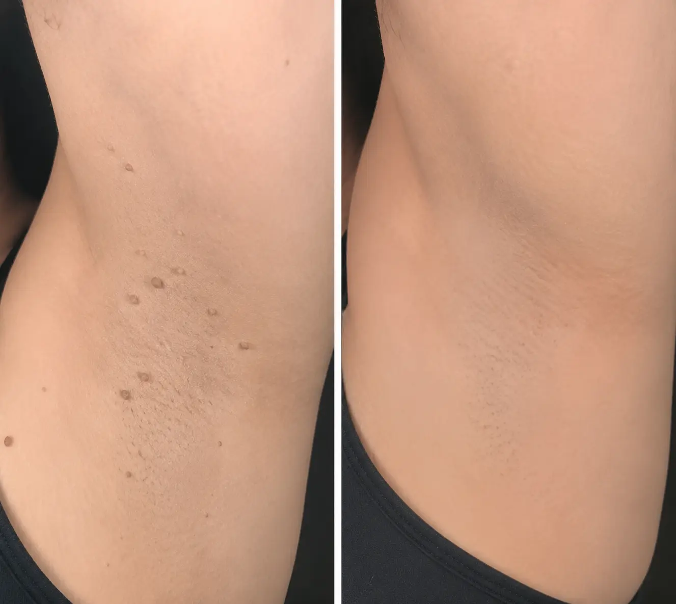 Alisanda®2-in-1 Microneedle & Hydrocolloid Patch