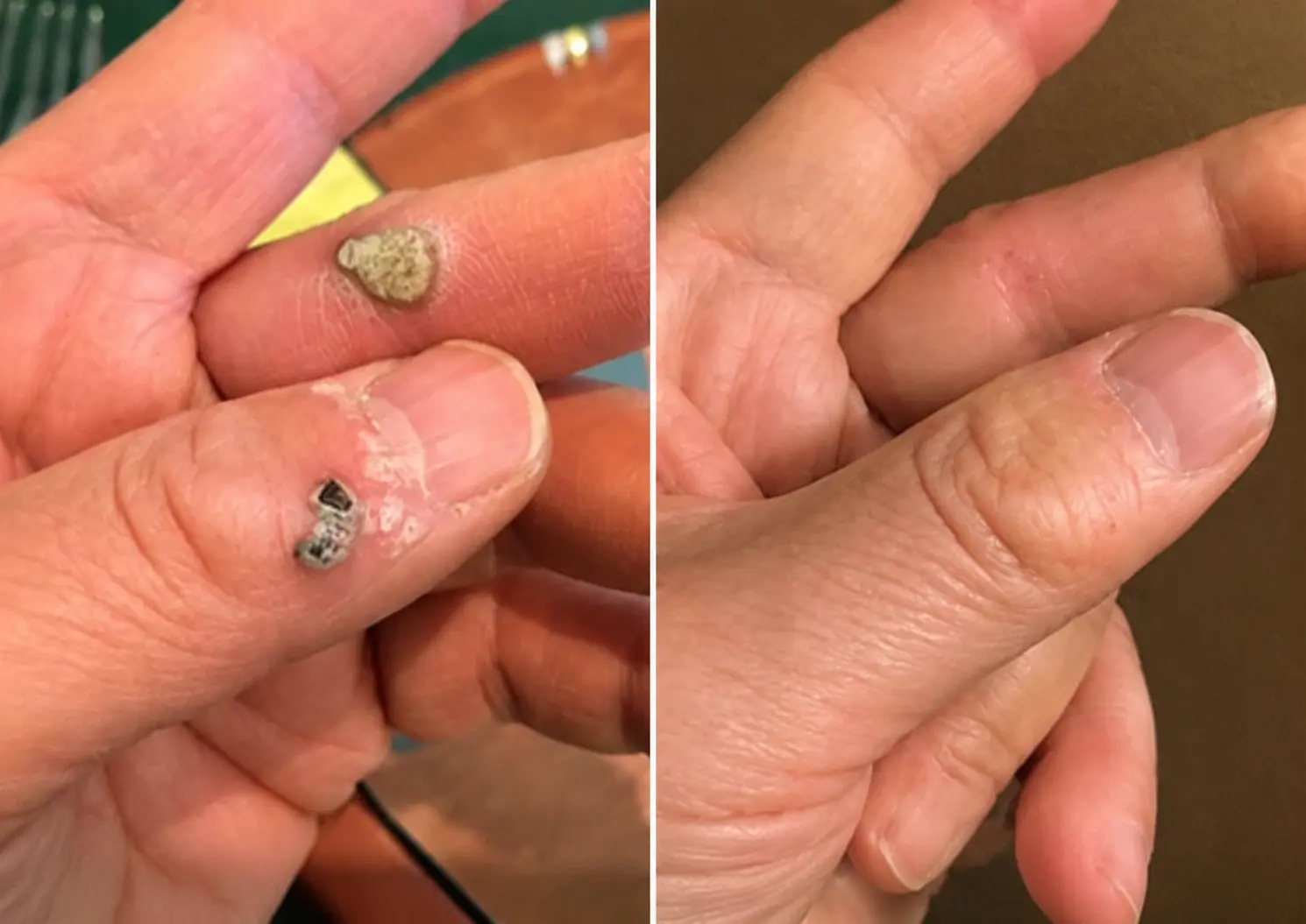 Alisanda®2-in-1 Microneedle & Hydrocolloid Patch