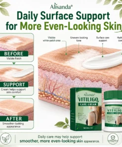 Alisanda® Herbal Vitiligo Cream