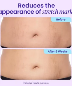 Alisanda® TummyRenew Firming & Smoothing Cream