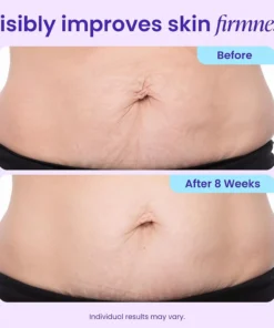 Alisanda® TummyRenew Firming & Smoothing Cream